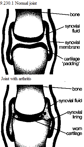 See diagram 9.230.1: Normal joint, Joint with osteoarthritis