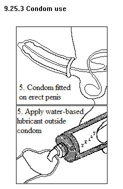 See diagram 9.25.2: Condom 3 and 4.