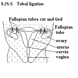 See diagram 9.25.5: Tubal ligation.