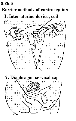 See diagram 9.25.6: Barrier methods of contraception.