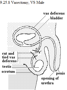 See diagram 9.25.8: Vasectomy.